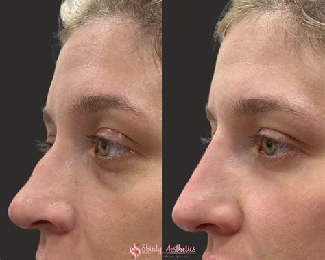 Liquid Nose Contouring