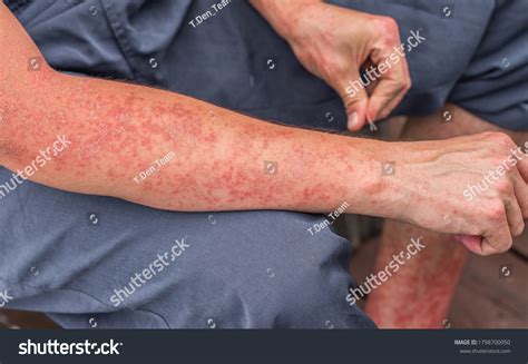 Dyshidrotic Autoimmune Eczema Patient Concept Health Stock Photo 1798700950 | Shutterstock