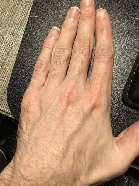 Why Are My Knuckles Wide at Karan Katz blog