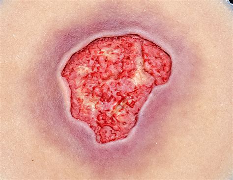 Stage 3 Pressure Injury – Techline Trauma