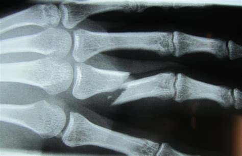 How do I know if my finger is broken? - John Erickson, MD