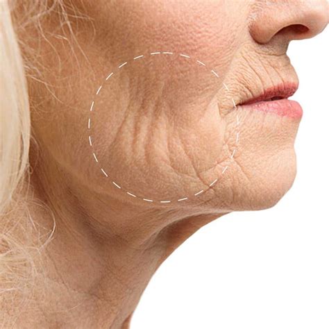 Crepey Skin Causes and Treatment Options - Dermedica