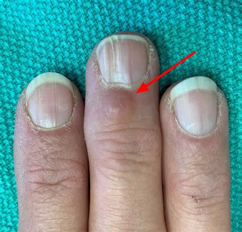 Inclusion Cyst On Toe – Ganglion cyst on foot: Pictures, cause, symptoms, and treatment – AUORN