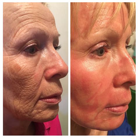 Co2 Laser Resurfacing - The Aesthetic Xpert