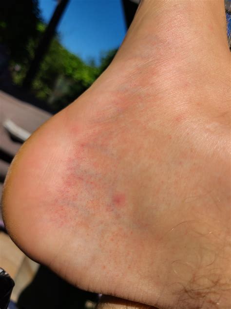 Any idea what this rash on side of foot is? Has not went away for a ...