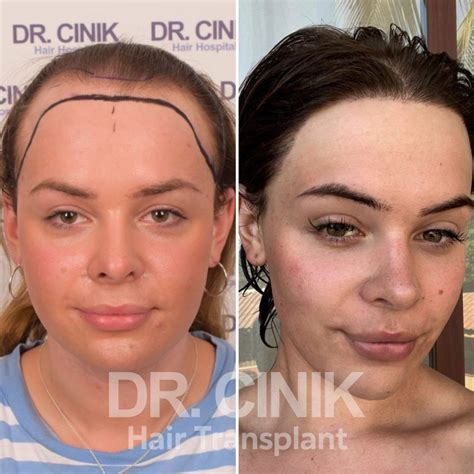 Hair Transplant for Women in Turkey: Cost, Procedures, Results | Dr ...