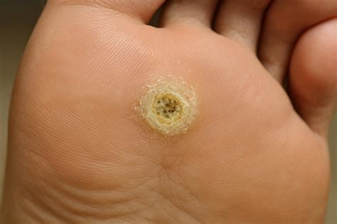 Ojo de pescado en el pie: Causas, síntomas y cómo quitarlo