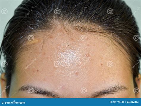 Acne Scars Forehead