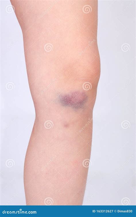 The Bruise On His Knee. The Bruise On His Leg. Stock Photography | CartoonDealer.com #85892144