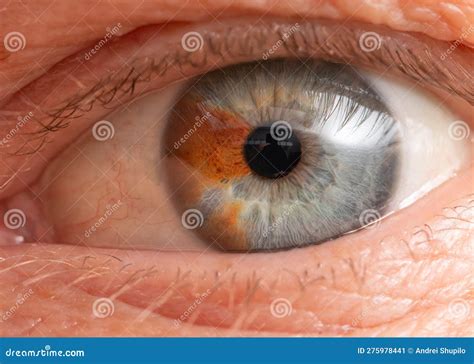 Birthmark in the Eye. Close-up. Stock Image - Image of retired, human ...