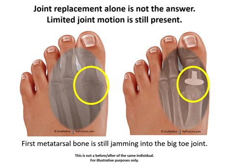 Jammed Toe Injury