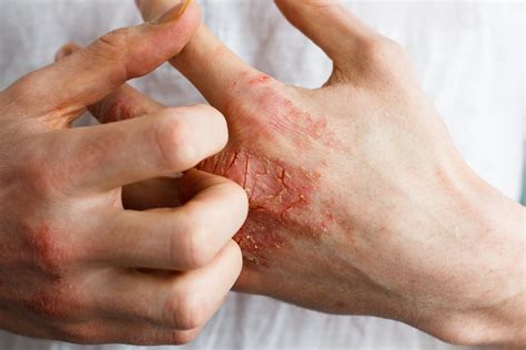Everything You Need To Know About Managing Eczema - SelfDecode Health