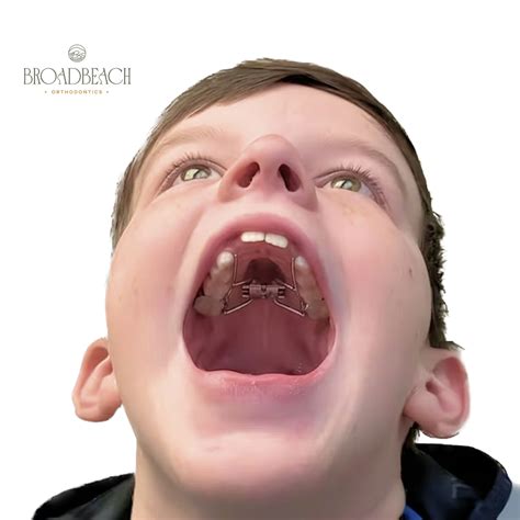 How to Activate Your Child's Palatal Expander: A Step-by-Step Guide - Broadbeach Orthodontics ...