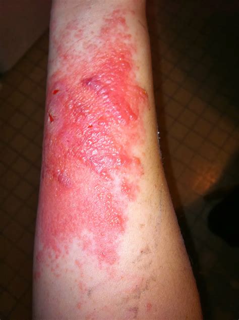 Pictures Of Poison Ivy Rash On The Skin at Brenda Rasheed blog