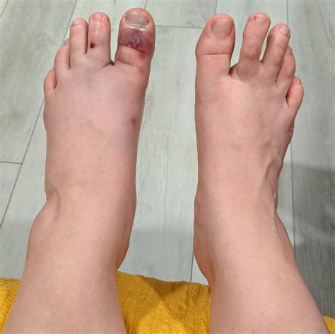 Traditional Chinese Medicine Case Report: Broken Big Toe — Alina Rehkopf