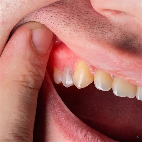 Can Gum Disease Be Reversed? - The Smile Studio