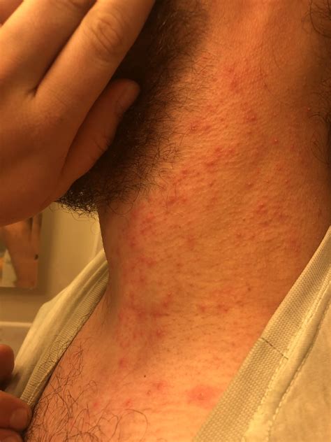 Bumpy Itchy Rash On Neck