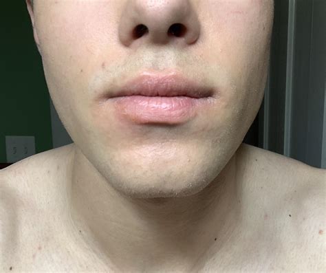 Itchy red bumps around my lips : r/AskDoctorSmeeee