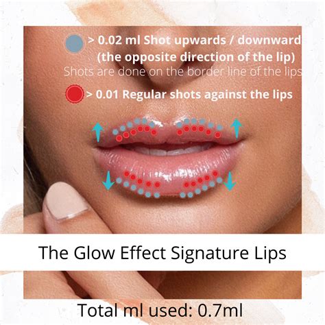 Hyaluron pen lip fillers mapping The Glow Effect | Lip fillers, Lips, Dermal fillers lips