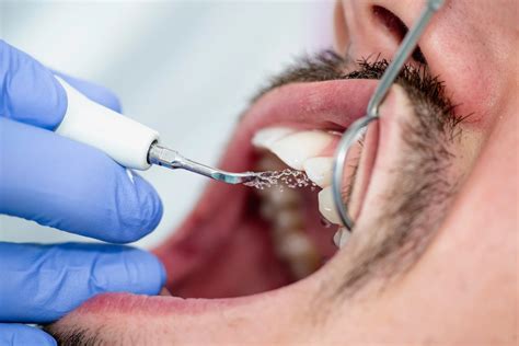 Deep Cleaning Teeth - Tam Dental