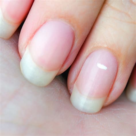 Large White Spot In Nail at Adolfo Scanlan blog