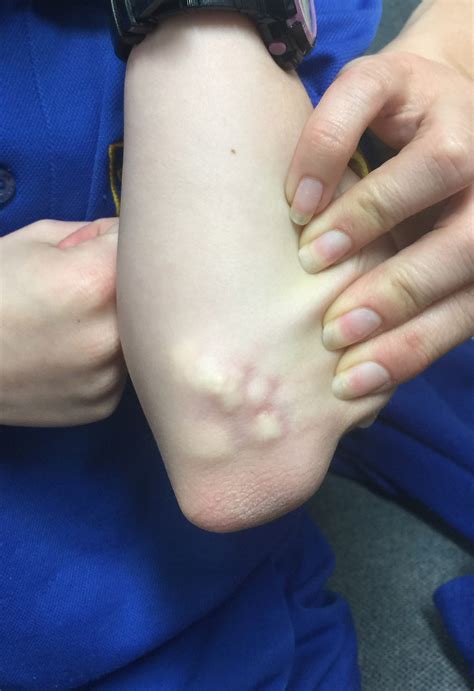 Mixed Connective Tissue Disease Back Pain at John Pavon blog