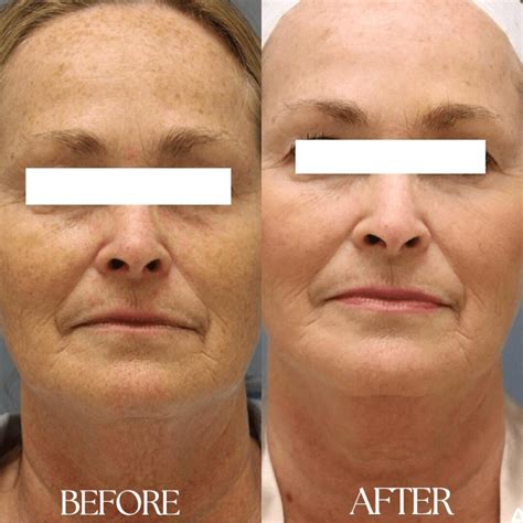 RF Microneedling Before & After Results