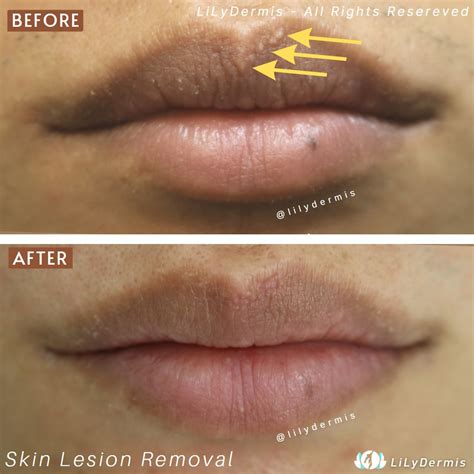 Fordyce Spots On Lips