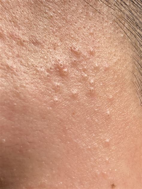 Clogged Pores Close Up