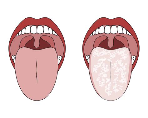 Dehydration Symptoms Tongue