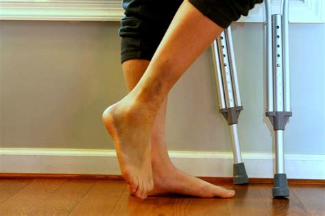 Can You Use Crutches With A Sprained Ankle at Harold Herron blog