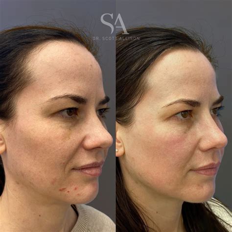 CO2 Laser Brisbane - Skin Resurfacing - Dr Scott Allison