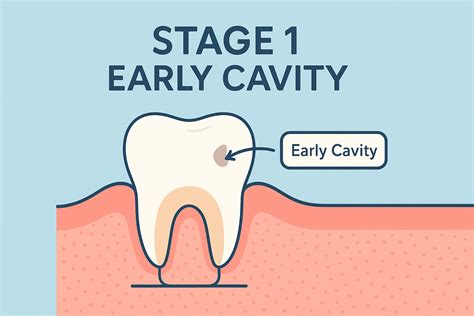 Stage 1 Early Cavity: What It Is and How to Treat It