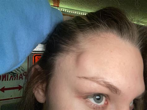 born with a hard but moveable lump on my head, doctors labeled it calcium buildup. in the past ...