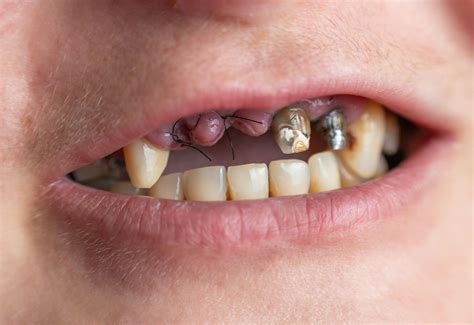 Dental Code For Suture Removal | Dental Suture Manufacturer