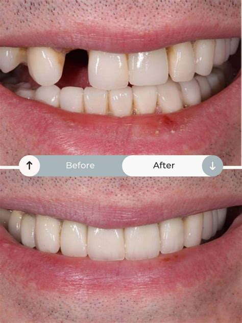 All on 6 | Costs, Process & More | The Perfect Smile Studios