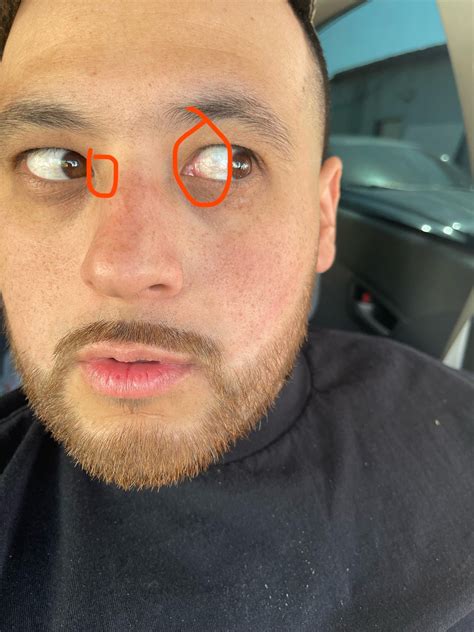 red veins in inner corner of eyes i have really bad photophobia that keeps getting worse am i ...