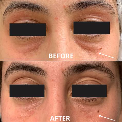 Fix Tired Face Without Surgery