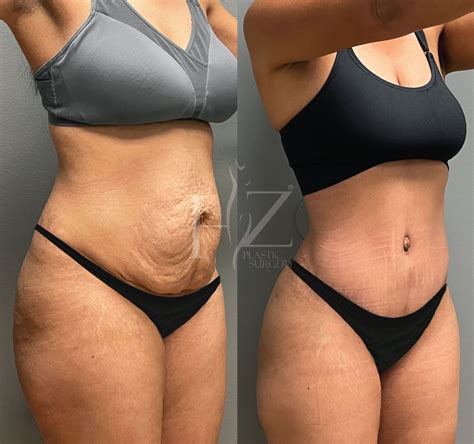 Here s what really happens when you have a tummy tuck – Artofit