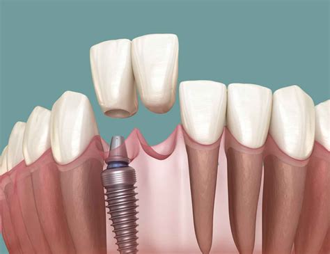 Front Dental Implants