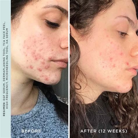 Do High-Frequency Wands Work for Acne? Derms Explain