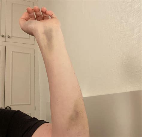 What does this wrist bruise mean 16 days after an elbow fracture? : r ...