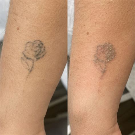 Complete tattoo removal - Bronctattooaus.com
