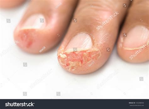 173 Small Itchy Blisters Images, Stock Photos & Vectors | Shutterstock