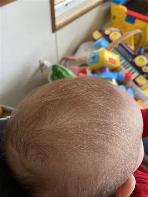 2.5 month old really dry scalp : r/newborns
