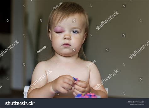 Mosquito Bite Baby Reaction at Mia Fortune blog