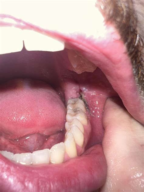 Wisdom Teeth Stitches Infected