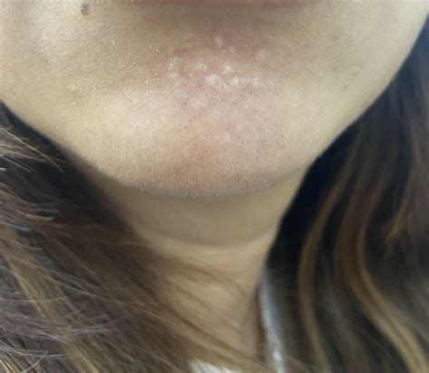 I(35f) have developed these small bumps on my chin. More in comments ...