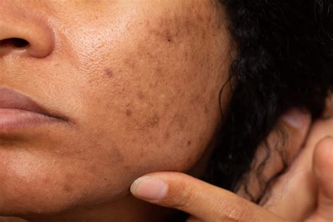 Las manchas de tu cara ¿son melasma? | Ferbos Medic