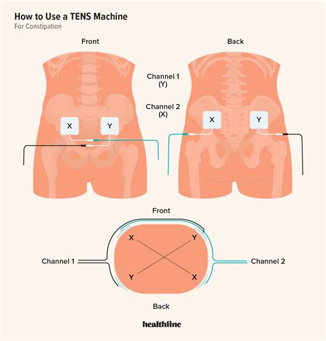 Can A Tens Unit Strengthen Pelvic Floor Muscles - Infoupdate.org